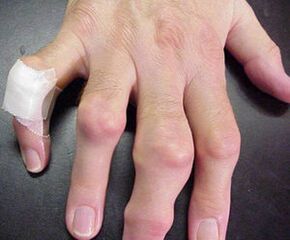 Finger pain with joint deformity