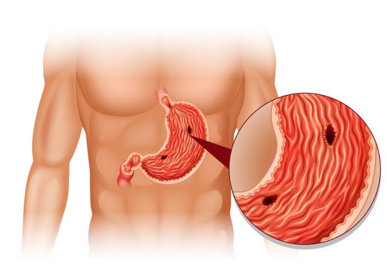 Ulcer as a cause of pain under the left scapula behind;