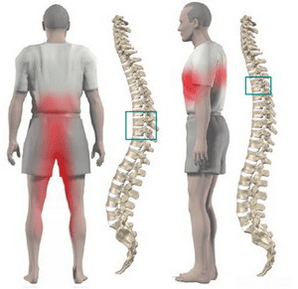 Back pain in thoracic osteochondrosis