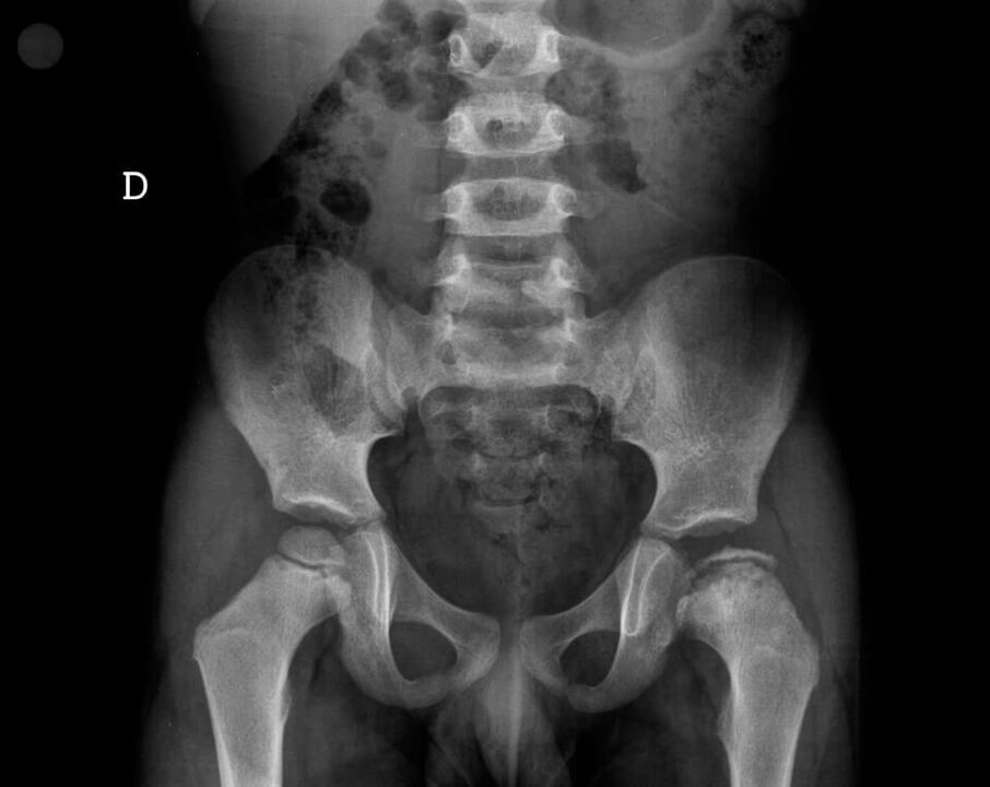 Legg-Calve-Perthes disease – necrosis of the cartilage tissue of the femoral head