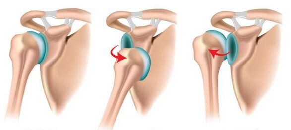 Anterior and posterior displacement of the shoulder joint, provoking the development of arthrosis