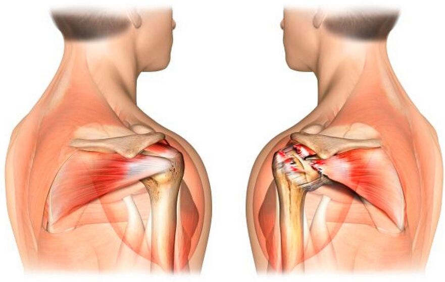Healthy and arthrosis affected shoulder