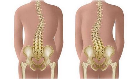 Non -Sarvasmati Scoliosis