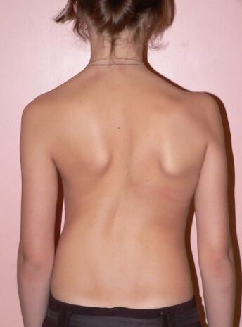 Scoliosis 2 degrees