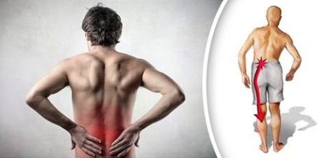Pain syndrome with lumbar osteochondrosis radiation in the feet