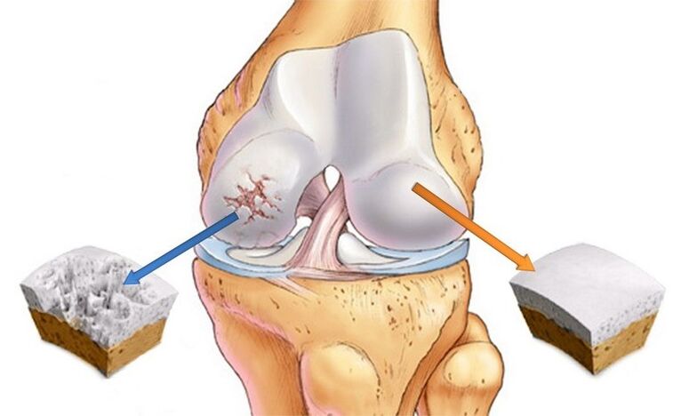 Affected by general cartilage and arthrosis