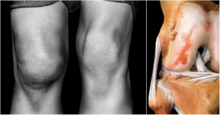 Arthrosis of the knee joint and throat