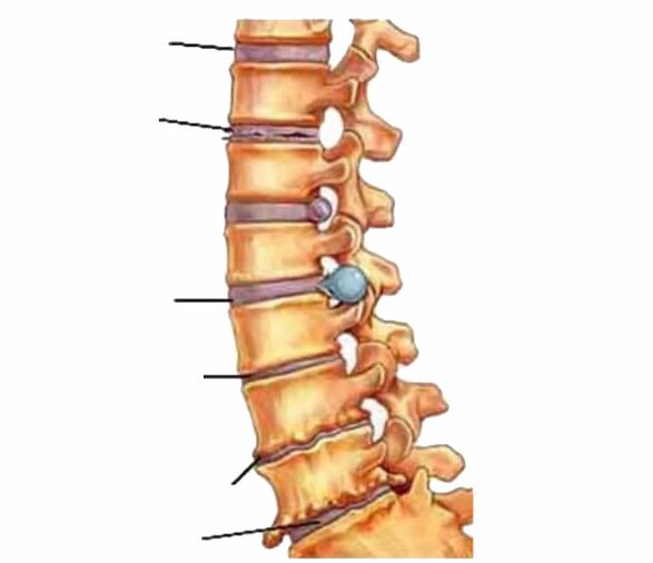 Back pain caused by damage to the spinal cord