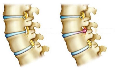 Healthy Discs and Disc Herniation