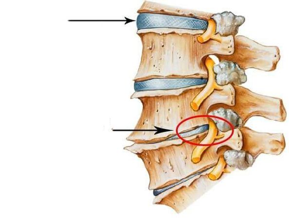 Normal and damaged discs in the spine