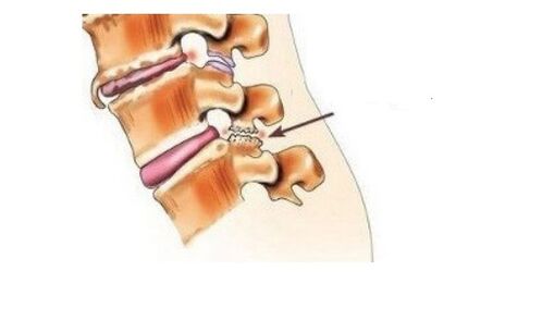 Spondyloarthrosis causes back pain