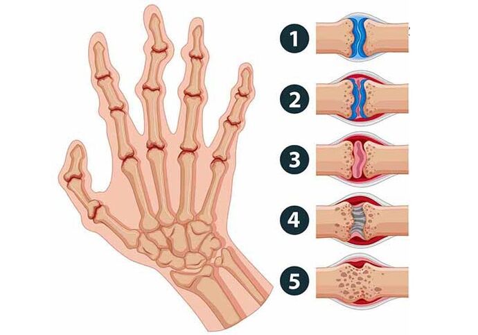 Stages of development of arthritis of the joints of the fingers