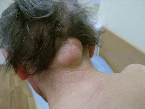 Swelling in neck due to pain