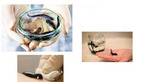 Hirudotherapy for arthrosis