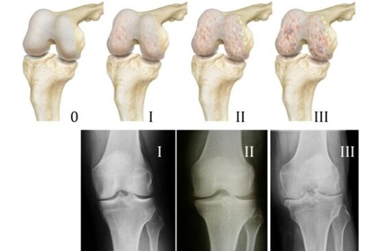 Methods of diagnosing knee arthrosis